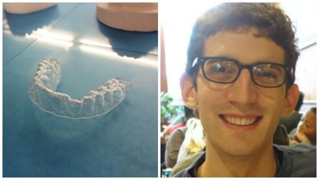 Niente soldi per apparecchio per denti lo costruisce da solo